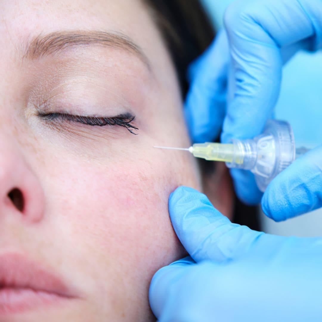 Ácido Hialurônico e Laser: Soluções Avançadas para Olheiras Profundas e Escuras