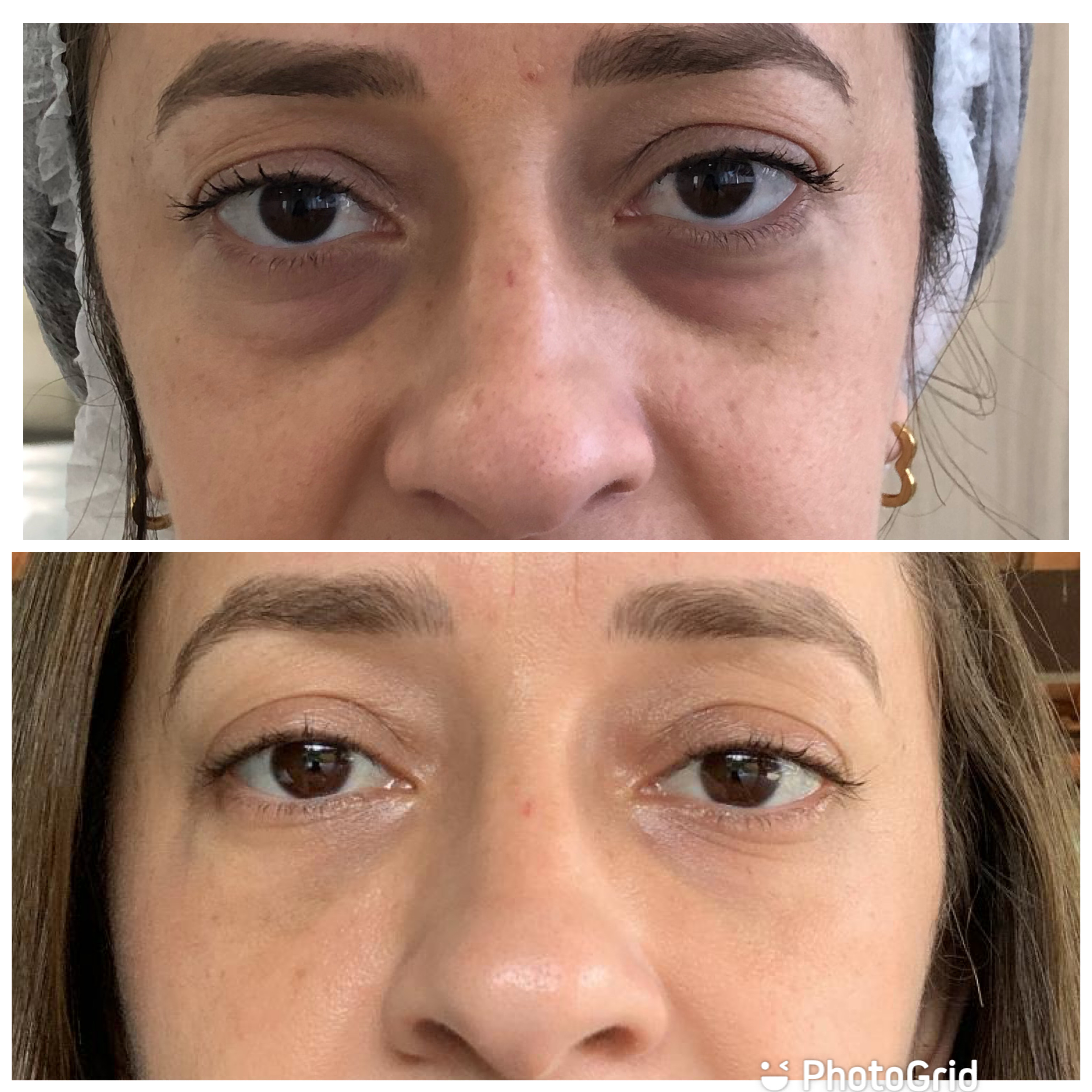 redução de olheiras