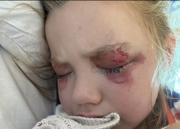 Diferença entre irritação e queimadura química na córnea: Sinais de alerta