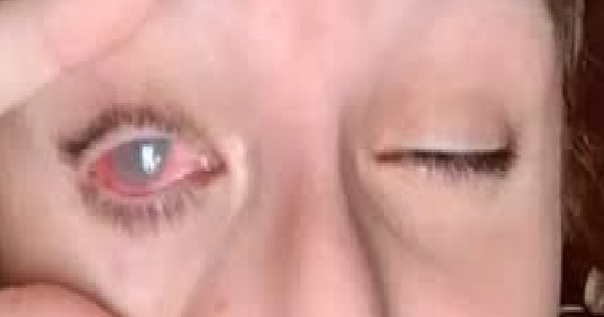 Mitos e verdades sobre o que fazer quando cai algo no olho