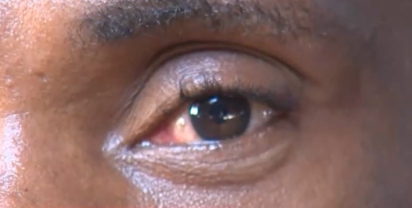 Guia completo: Primeiros socorros para acidentes oculares com produtos de limpeza