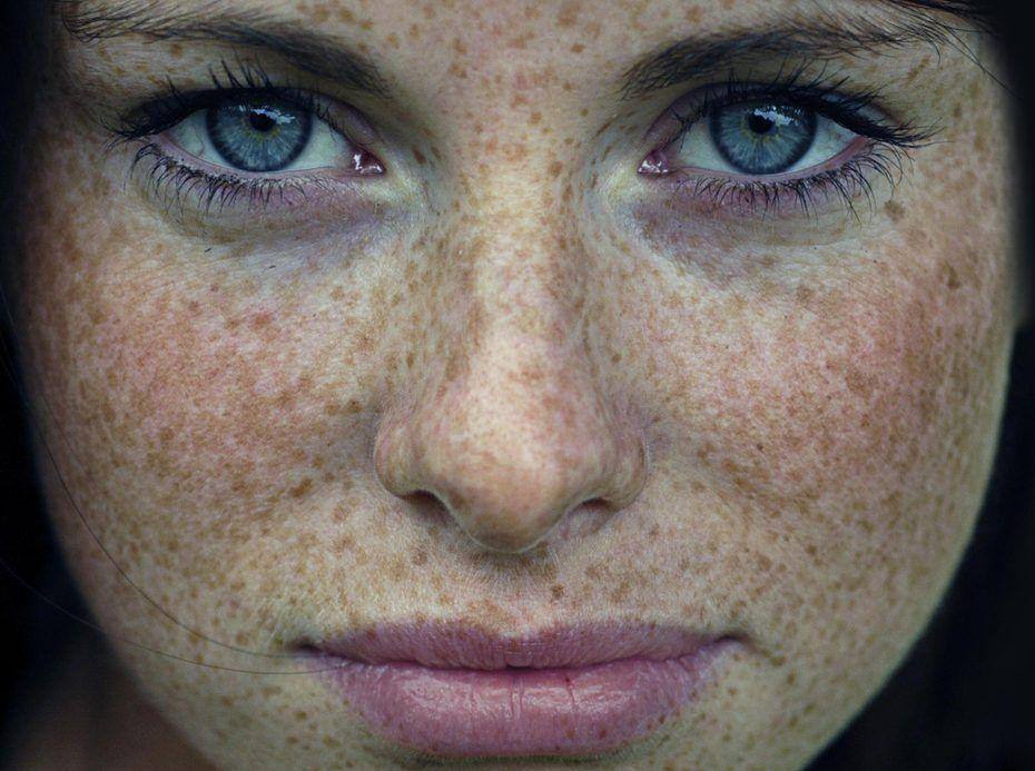 tratamentos para sardas