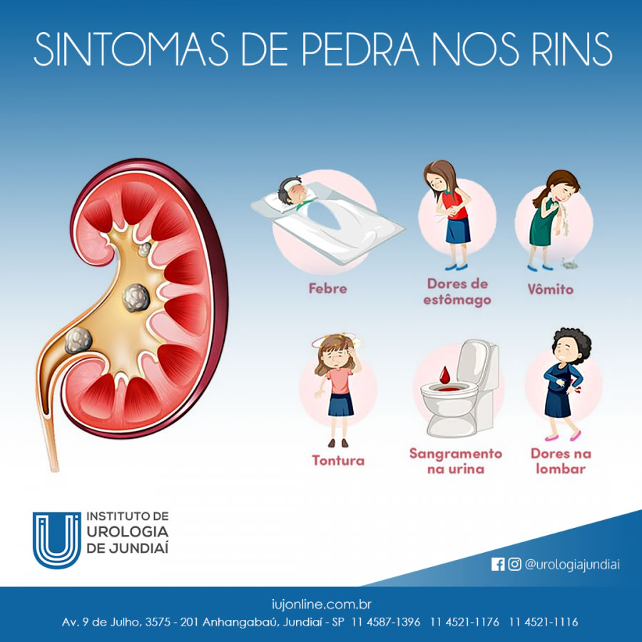 sintomas de cálculo renal em mulheres