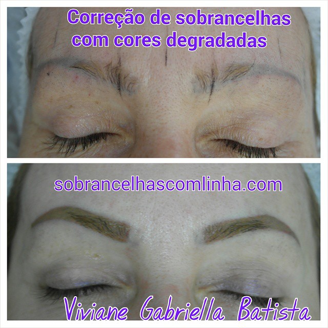 Despigmentação a Laser vs. Química: Qual o Melhor para Sobrancelhas Acinzentadas?