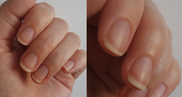 tirar cuticula faz mal