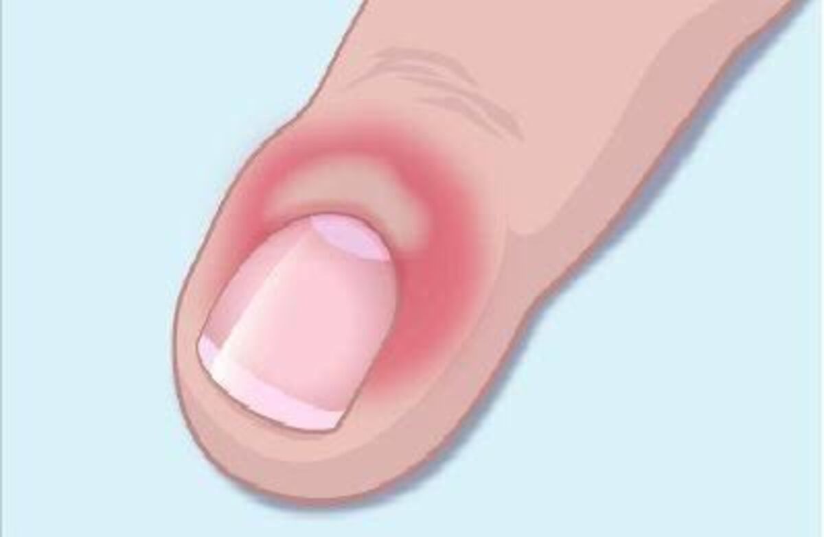 tirar cutícula causa infecção ou não