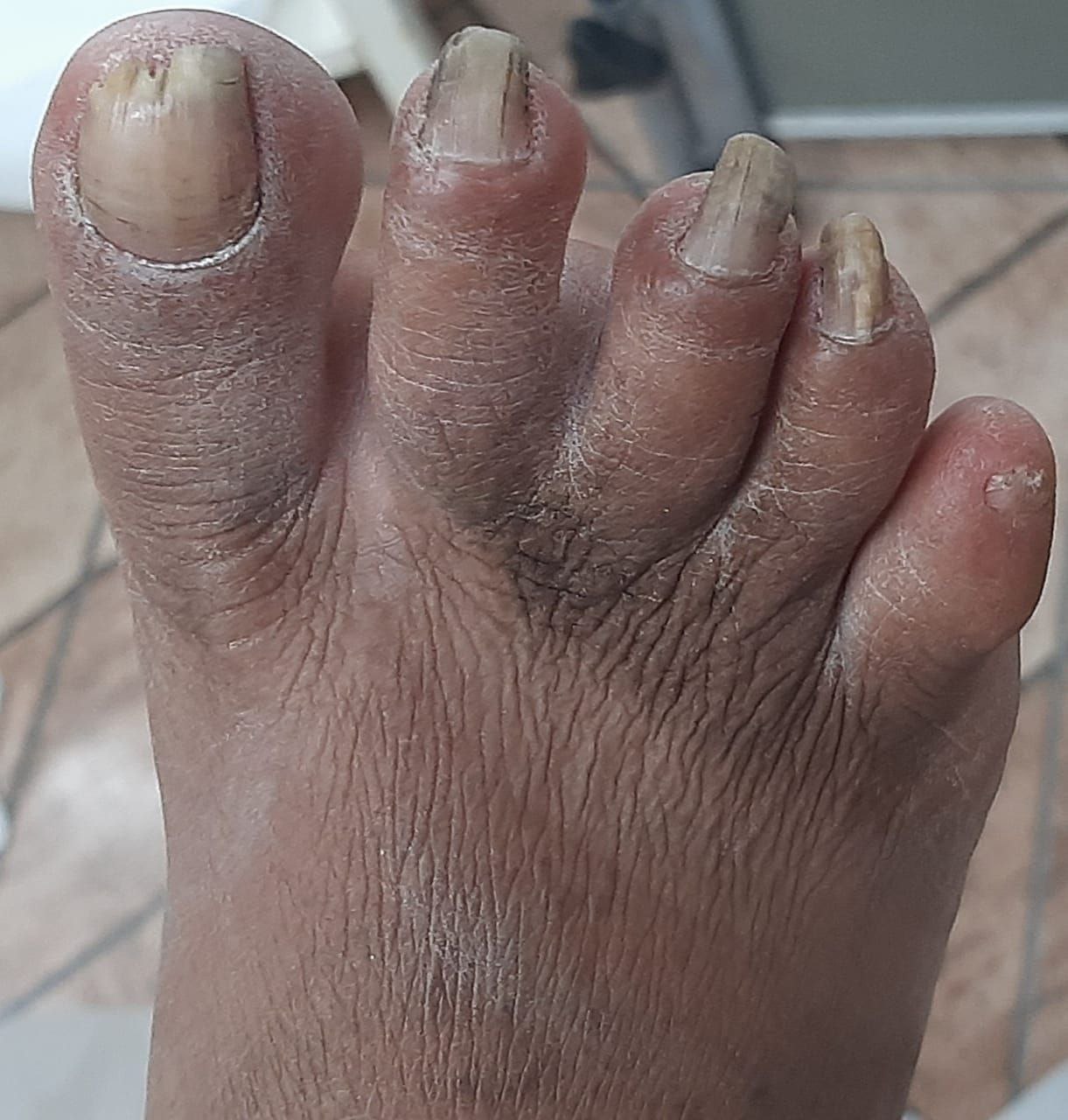 Micose nas unhas dos pés: sintomas