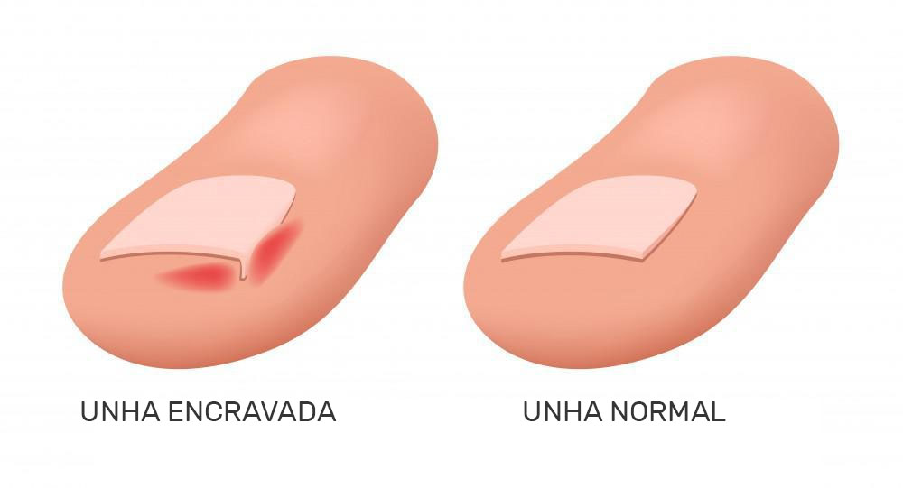 melhores formas de aliviar dor de unha encravada em casa