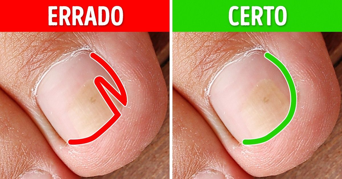 erros comuns ao cortar unhas que causam encravamento