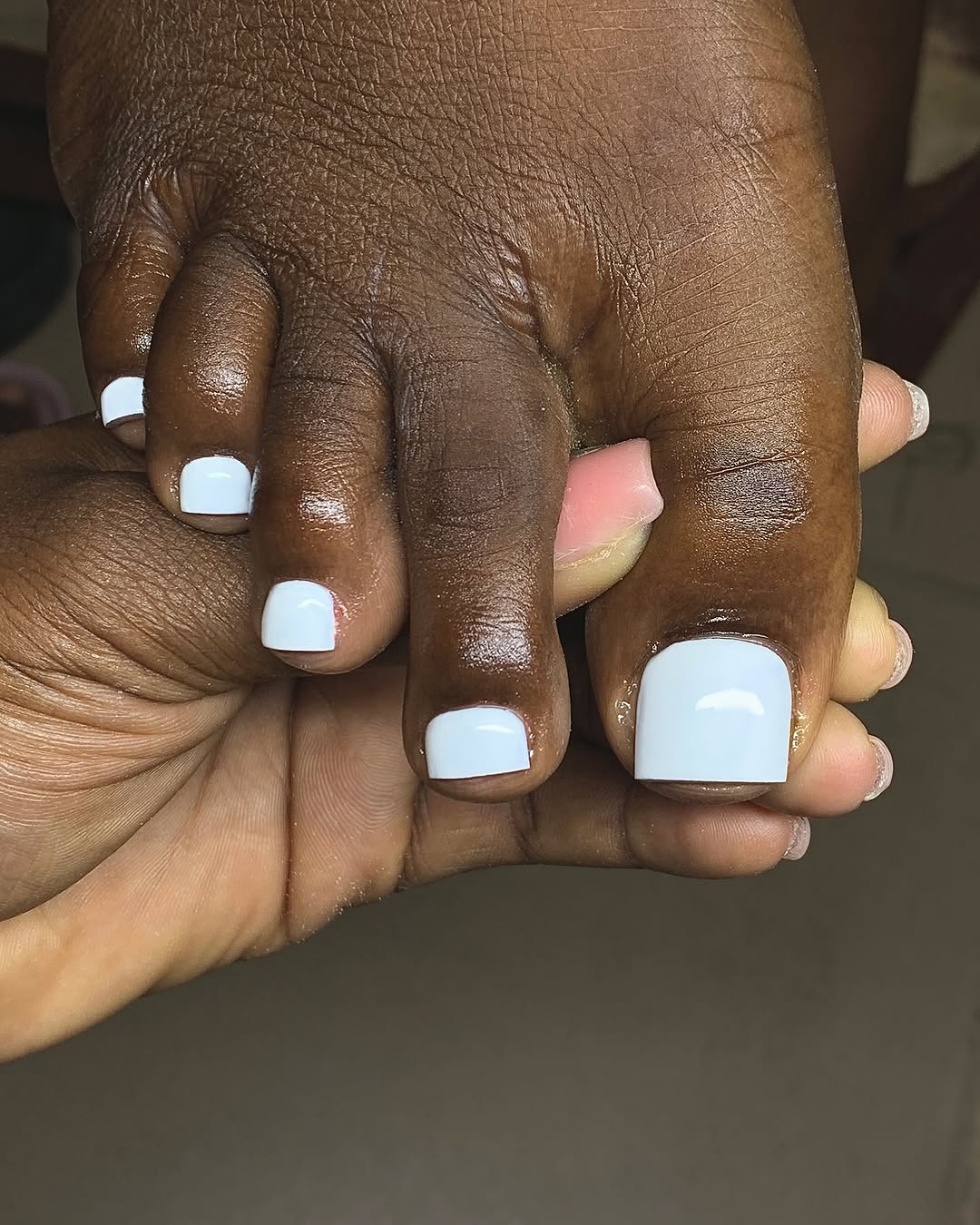 Leuconíquia: Entenda as Manchas Brancas nas Suas Unhas