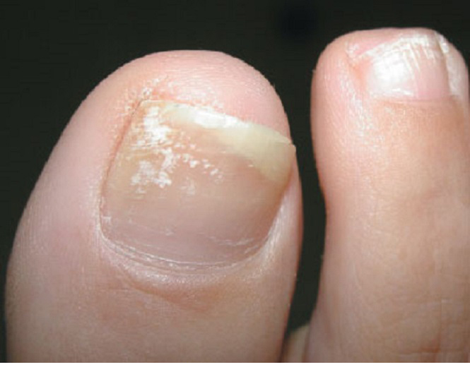 unhas dos pés ressecadas