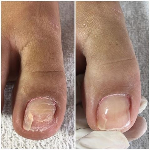 Hipotireoidismo e Unhas Quebradiças: Qual a Conexão?
