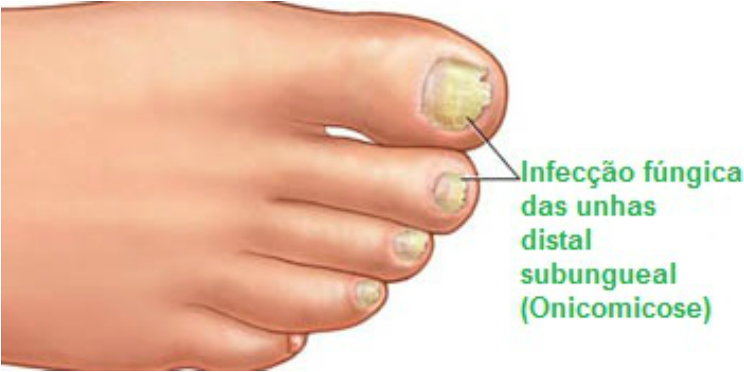 Guia Completo: Como Escolher o Melhor Creme para Pés e Unhas