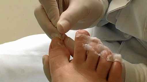 unhas dos pés ressecadas