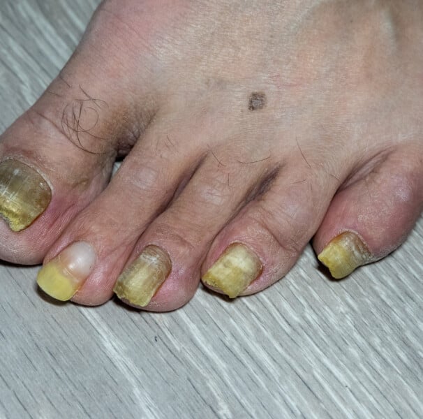 Os Benefícios da Vaselina e Nívea para Unhas dos Pés Ressecadas