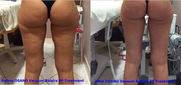 Velashape III preço por sessão